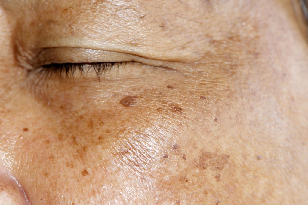 Hyperpigmentation West Melbourne