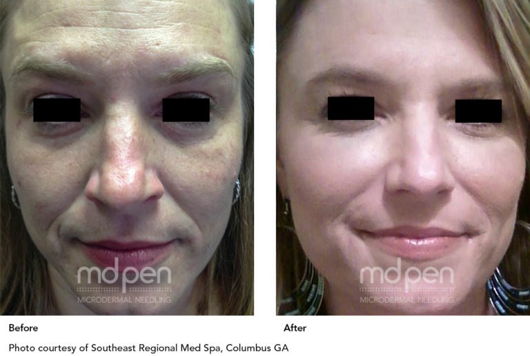 Microneedling West Melbourne