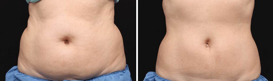 coolsculpting West Melbourne